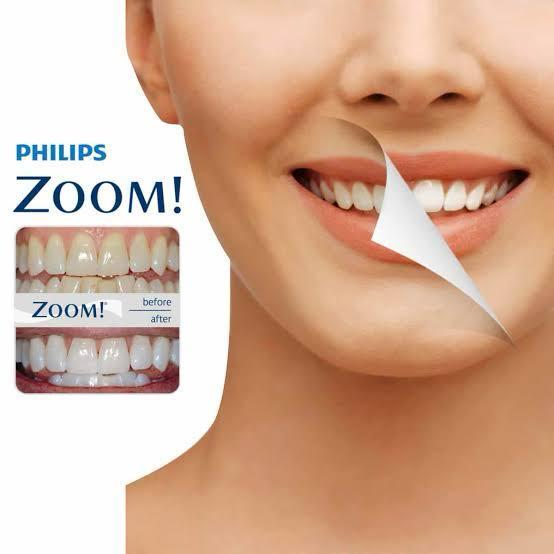 Phillips Zoom (Laser) Teeth Whitening